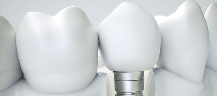 How Long Does A Dental Implant Last?
