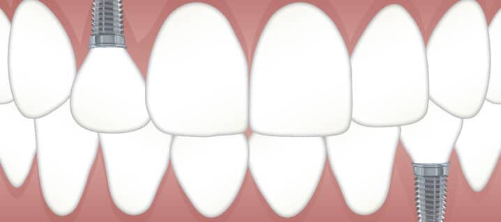 What Happens If A Missing Tooth Is Not Replaced?